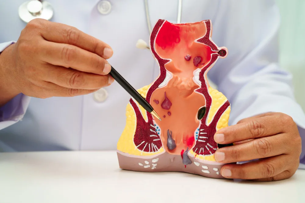 Fístula anal en CDMX y Naucalpan: atención coloproctológica especializada