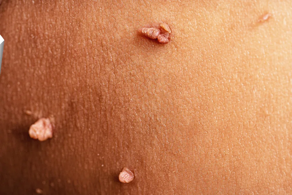 Virus del papiloma humano